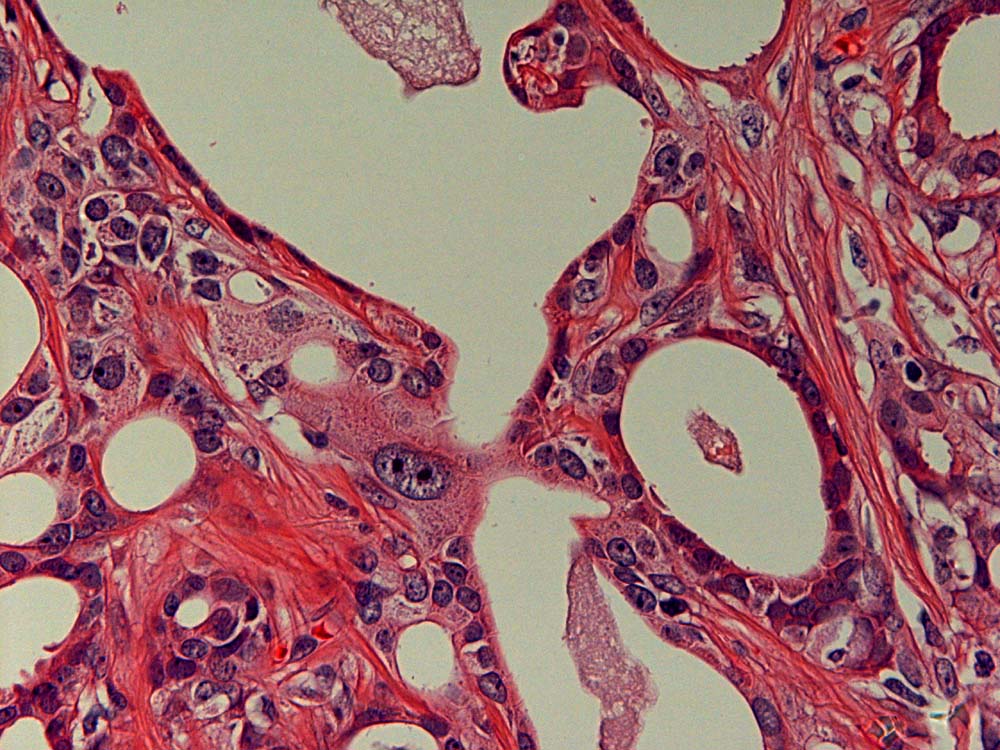 Pathology Outlines Ductal Adenoma